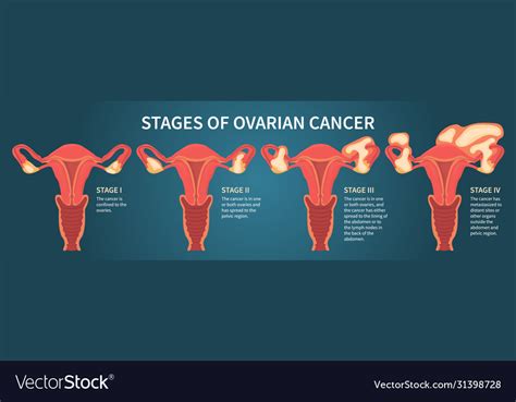 end stage ovarian cancer symptoms timeline|final weeks of ovarian cancer.